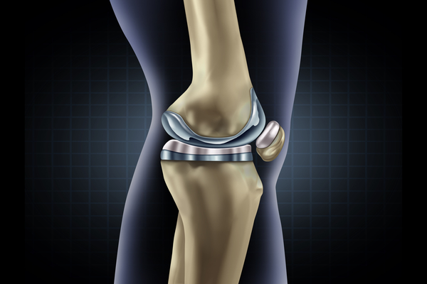 Knee replacement implant medical concept as a human leg anatomy after a prosthetic